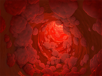علائم کلسترول و چربی خون بالا