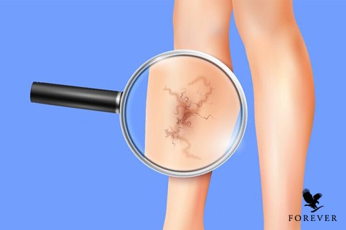 بیماری واریس